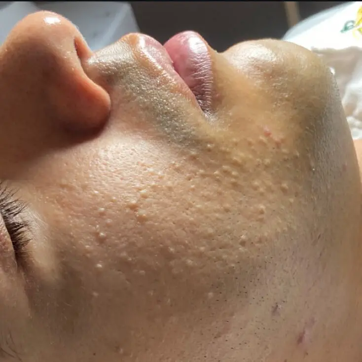 Glow Skin Extracción Limpieza Facial Peeling Porcelanizacion