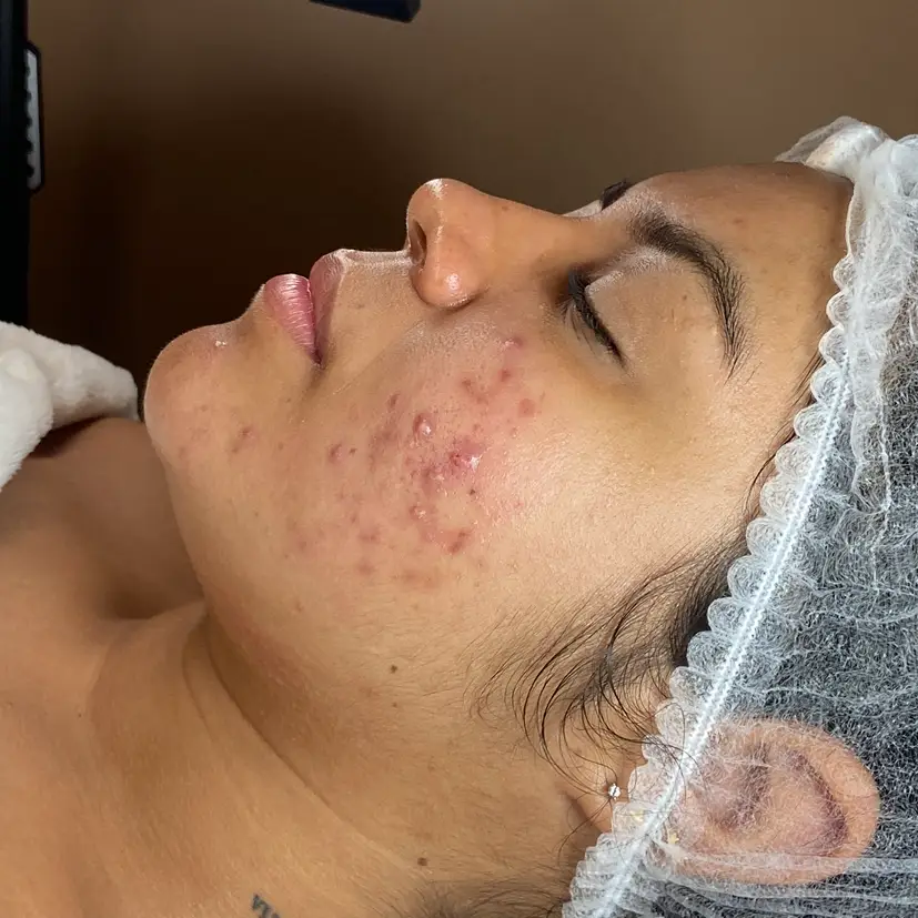 Glow Skin Extracción Limpieza Facial Peeling Porcelanizacion