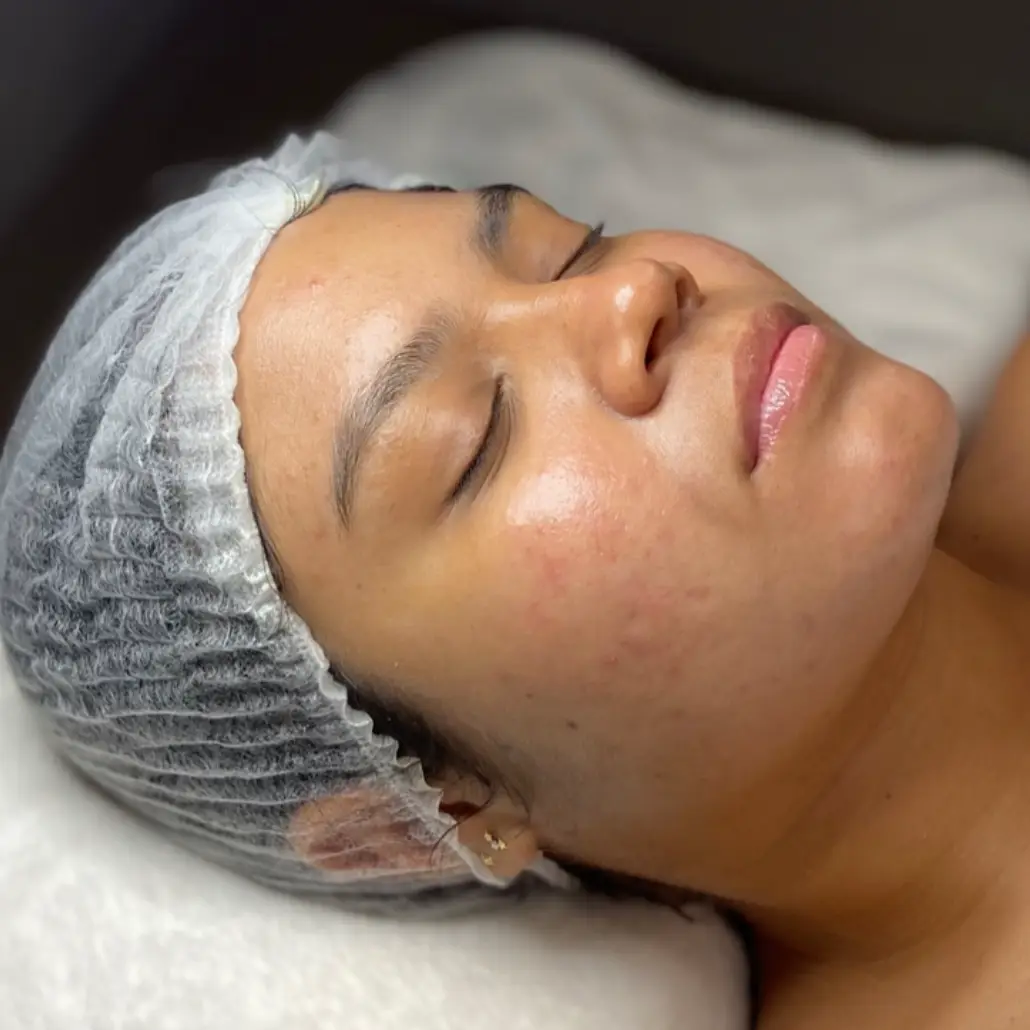 Glow Skin Extracción Limpieza Facial Peeling Porcelanizacion