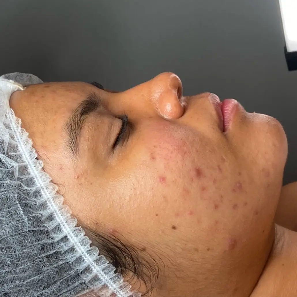 Glow Skin Extracción Limpieza Facial Peeling Porcelanizacion
